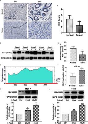 3,3’-Diindolylmethane Enhances Paclitaxel Sensitivity by Suppressing <mark class="highlighted">DNMT1</mark>-Mediated KLF4 Methylation in Breast Cancer